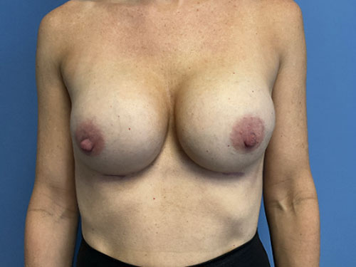 Breast-Augmentation--Case-Study-2573 | After Breast Augmentation