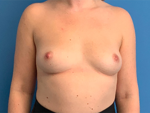 Breast-Augmentation--Case-Study-2358 | Before Breast