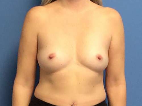 Breast-Augmentation--Case-Study-9246 | Before Breast Augmentation