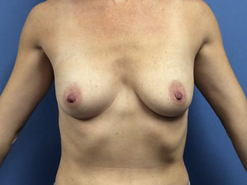 Breast-Augmentation--Case-Study-2573 | Before Breast Augmentation
