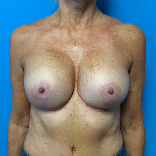 Breast-Revision--Case-Study-3178 | After Breast