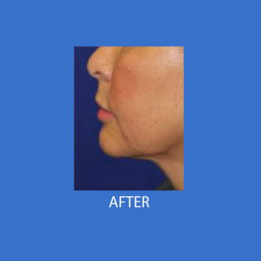 After Image