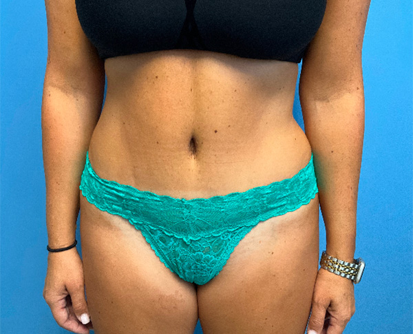 Tummy-Tuck-with-Liposuction--Case-Study-7314 | After Liposuction
