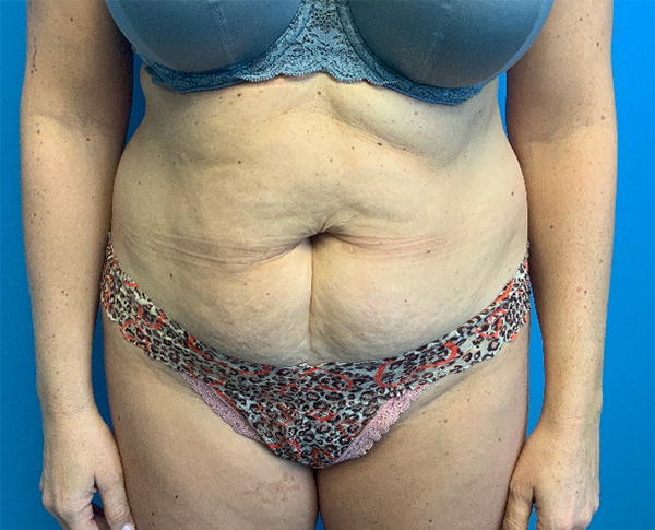 Tummy-Tuck-with-Liposuction--Case-Study-7314 | Before Liposuction