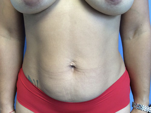 Tummy-Tuck--Case-Study-6638 | Before Body