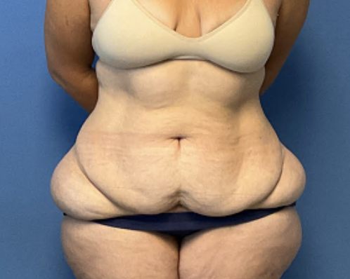 Tummy-Tuck--Case-Study-2951 | Before Body